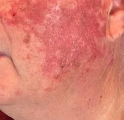 Rosácea – enrojecimiento facial en piel celta